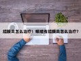 结膜炎怎么治疗！眼睛有结膜炎怎么治疗？